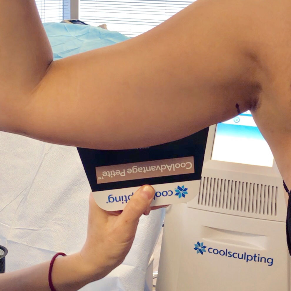 coolsculpting treatment under arms
