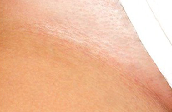 Bikini line after laser hair removal