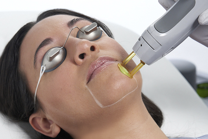 Laser Hair Removal on Chin