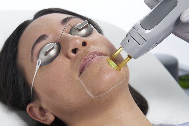 Laser hair removal face discount