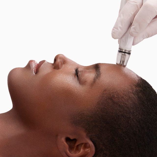 Closeup of a woman's head region receiving Diamond Glow treatment on her forehead region.