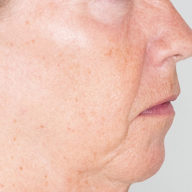 Side angle of a person's cheek, nose, and lip area.