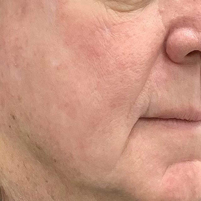 Closeup of a side angle of a person's cheek and mouth area.