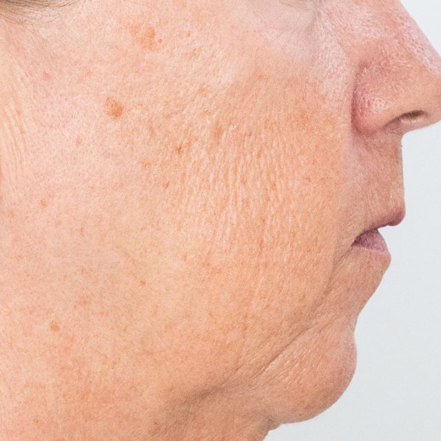 Side angle of a person's cheek, nose, and lip area.