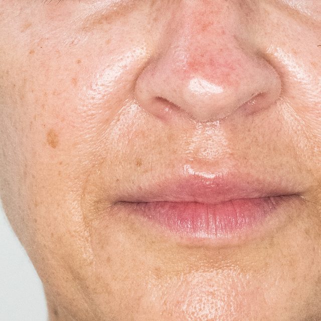 Closeup of a person's nose and lip area.