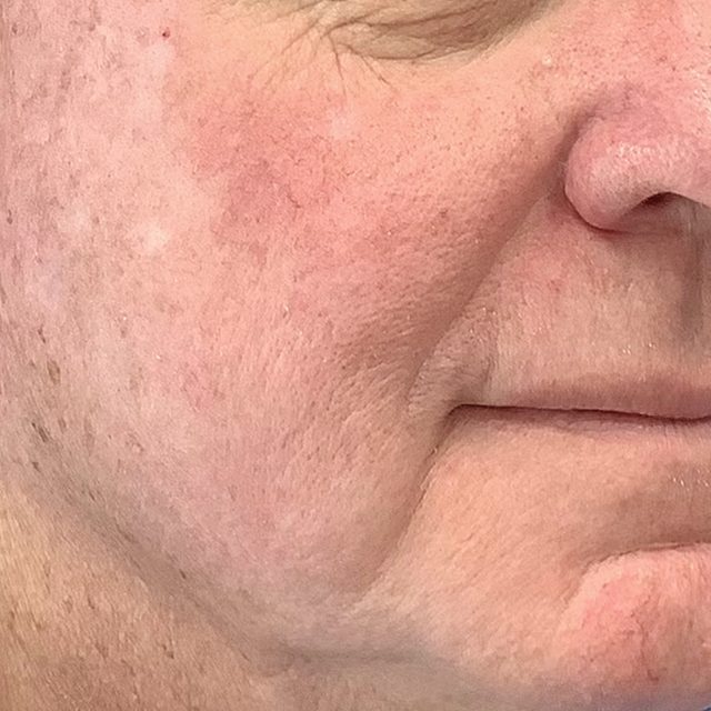 Closeup of a side angle of a person's cheek and lip area.