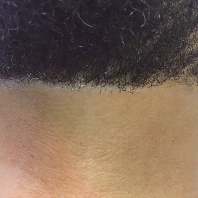 Closeup of a hairline.