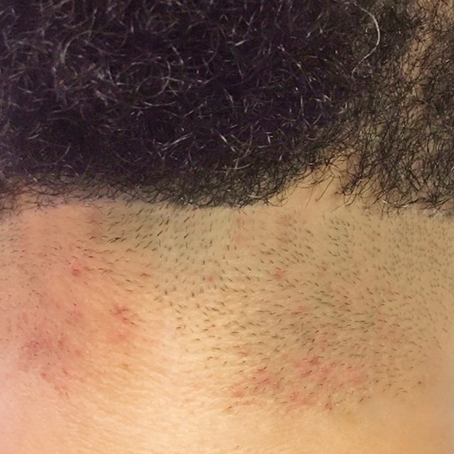 Closeup of the hairline area.