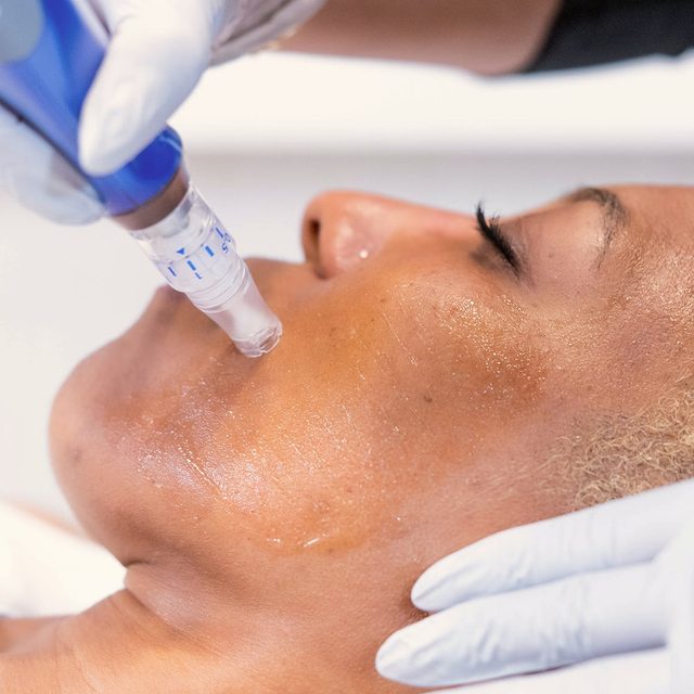 Woman with dark skin tine receiving microneedling on her face.