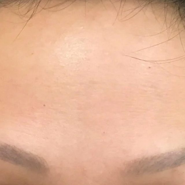 Closeup of a person's forehead region.
