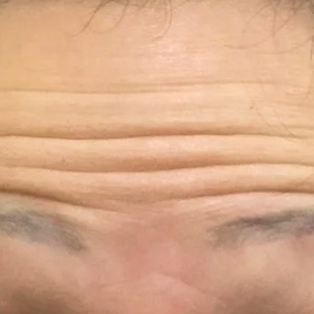 Closeup of a person's forehead area with wrinkles.