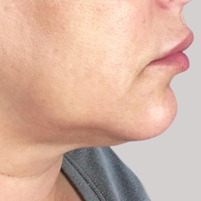 Side angle of a person's cheek and lip area.