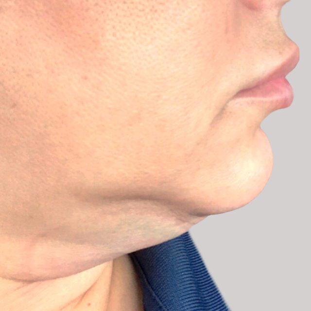 Side angle of a person's check, neck, and lip region.