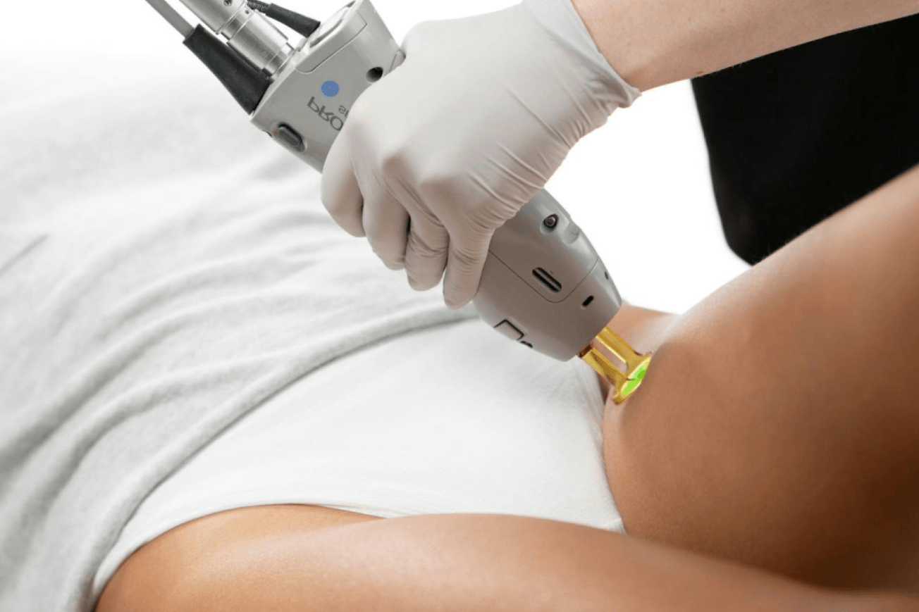 Woman with white clothing receiving laser hair removal treatment on upper thigh.