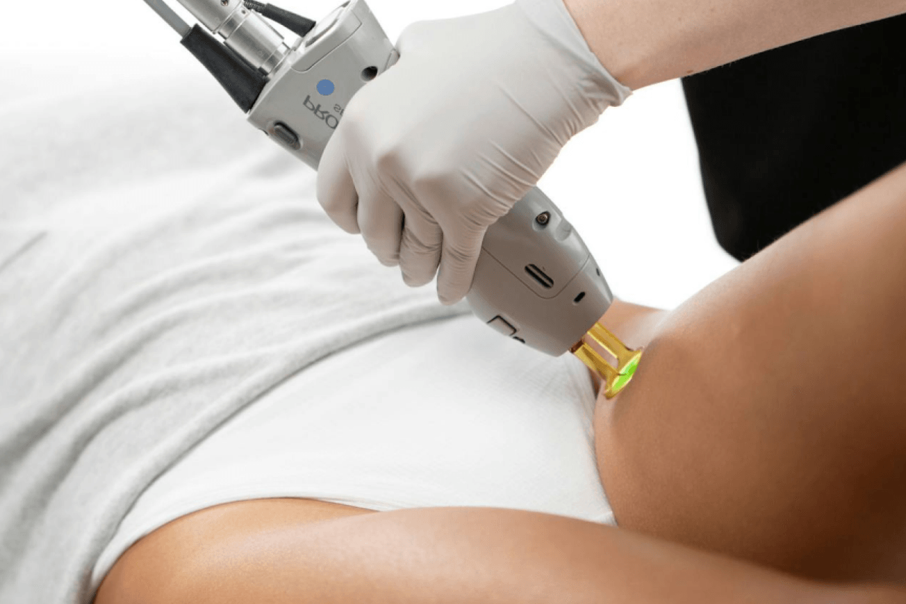 Woman with white clothing receiving laser hair removal treatment on upper thigh.
