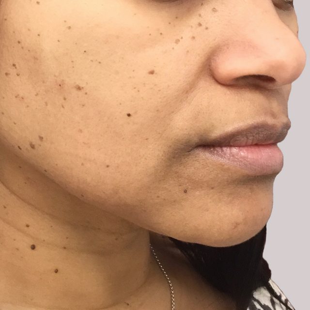 Side angle of a woman's cheek, nose, and lip area.