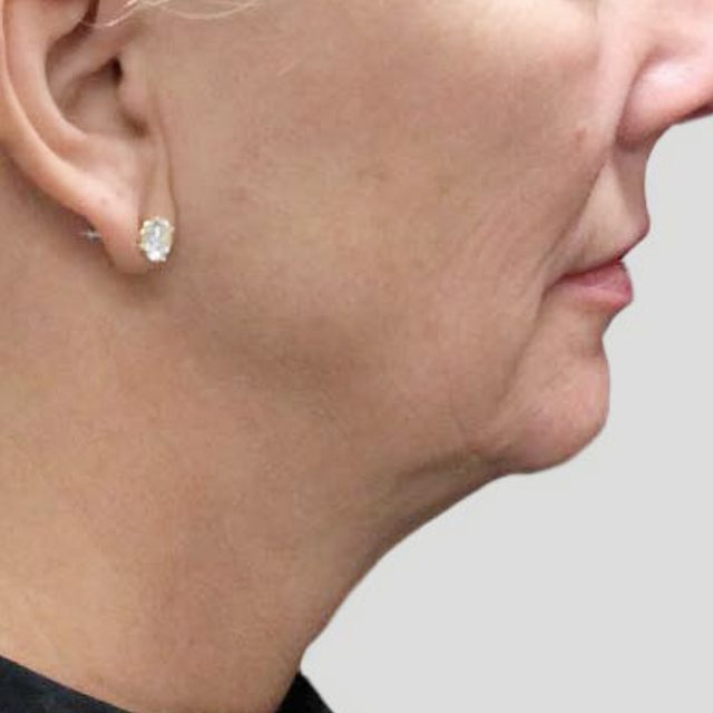 Side angle of a woman's cheek and neck area with a piece of jewelry in her ear.