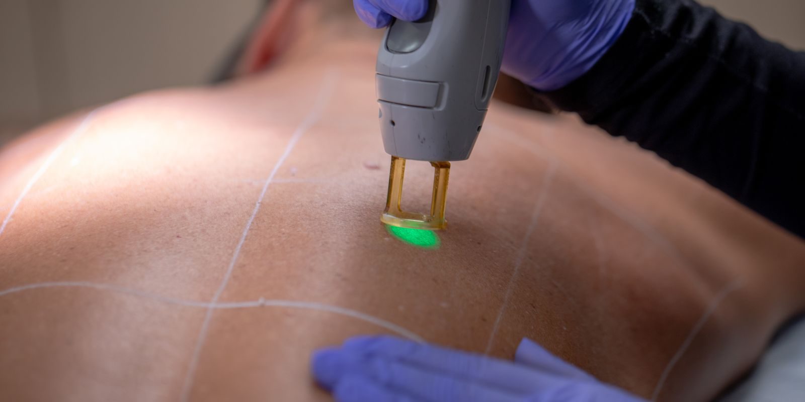 man receiving laser hair removal on back
