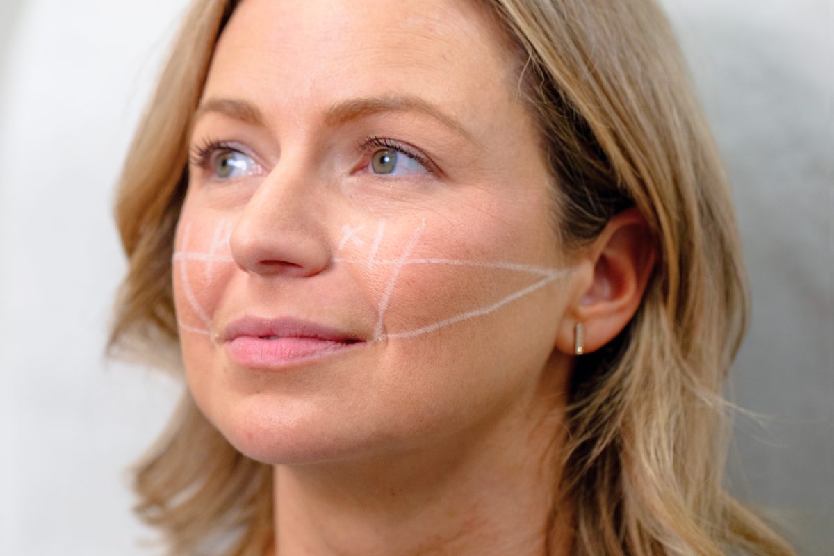 woman with treatment guides on her face