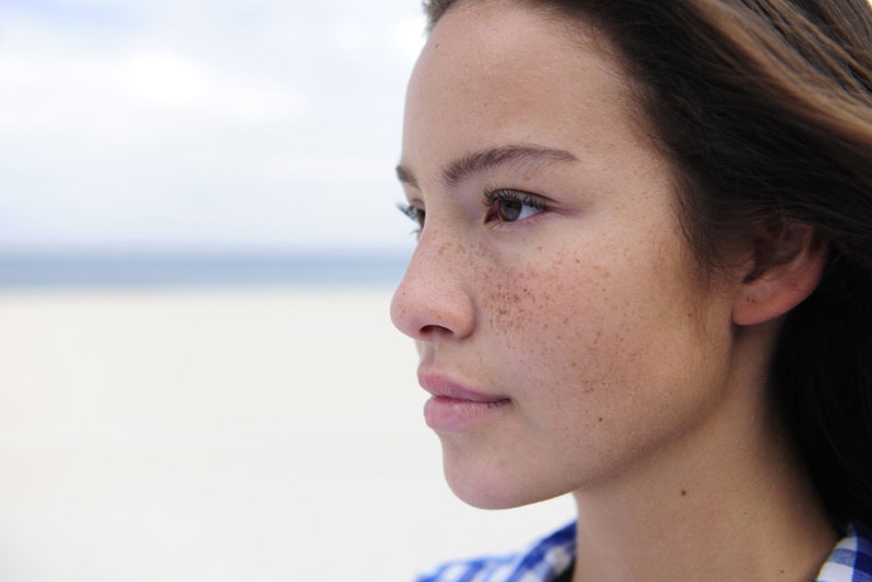 Freckles, also known as sunspots, are more prominent on fair skin.