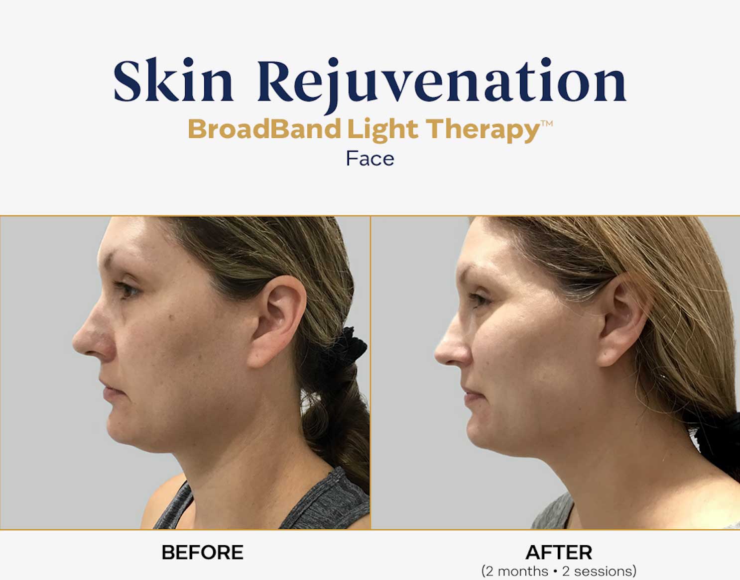 Skin Rejuvenation before/after