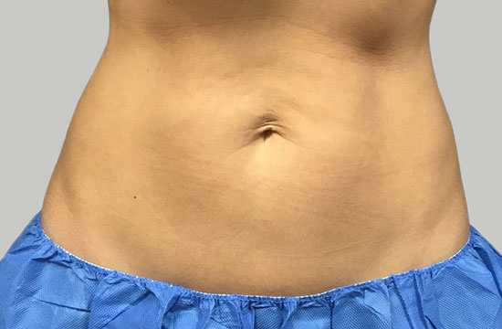 belly after coolsculpting