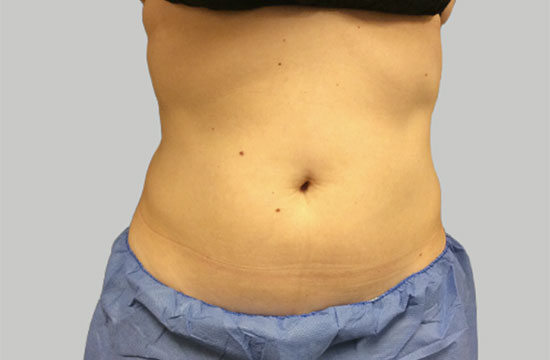 belly after CoolSculpting