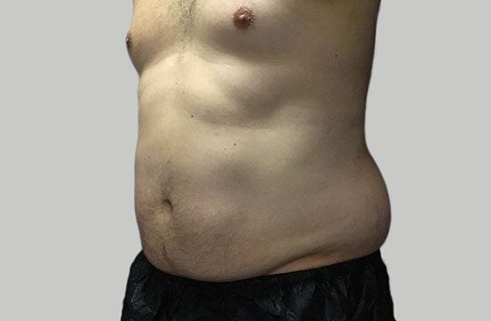belly after CoolSculpting