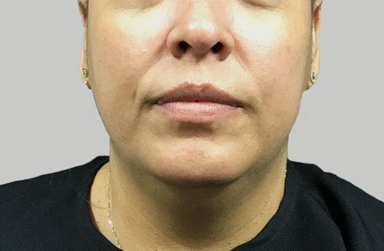 chin after CoolSculpting