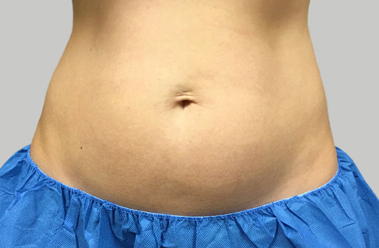 belly before coolsculpting