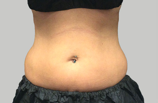 coolsculpting before photo belly