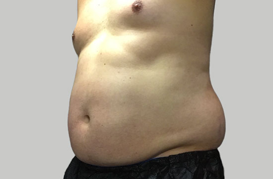 belly before CoolSculpting