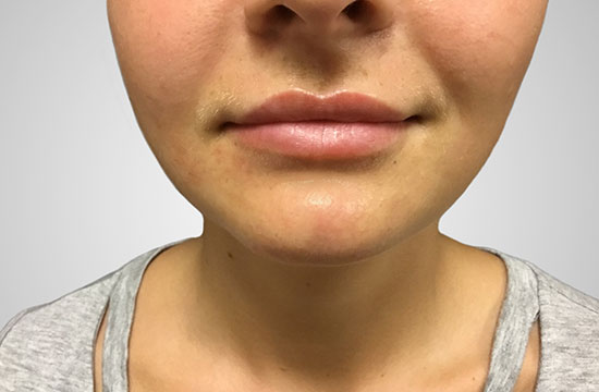 lips after treatment