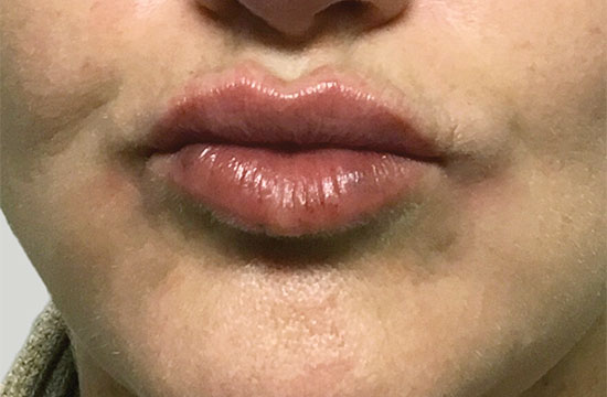 kissing lips after treatment