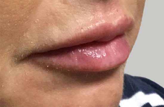lips after Juvederm