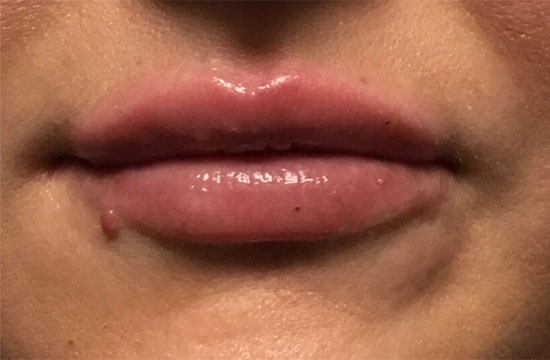 lips after Juvederm treatment