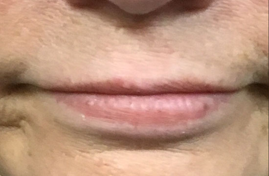lips before juvederm