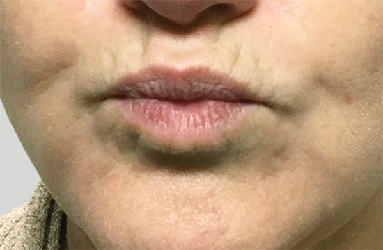 lips before treatment