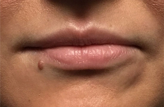 lips before Juvederm treatment