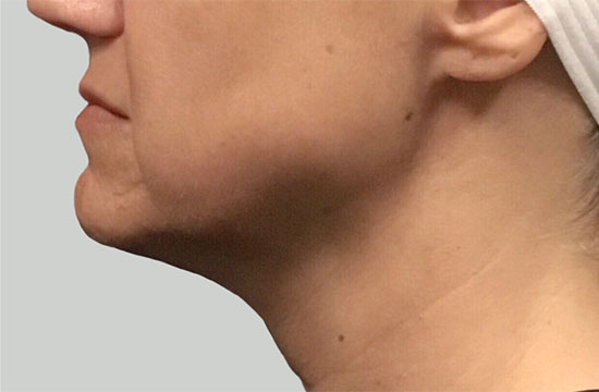 woman's chin before ultherapy