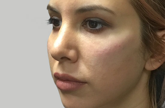 woman face after treatment