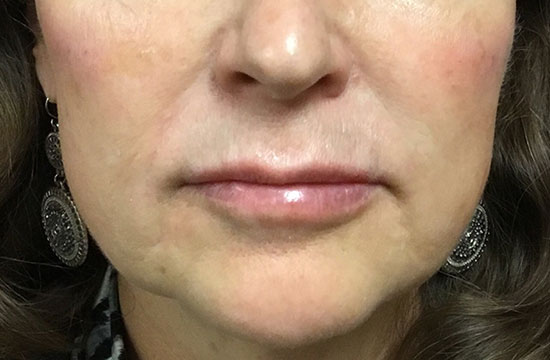 woman's lips after treatment