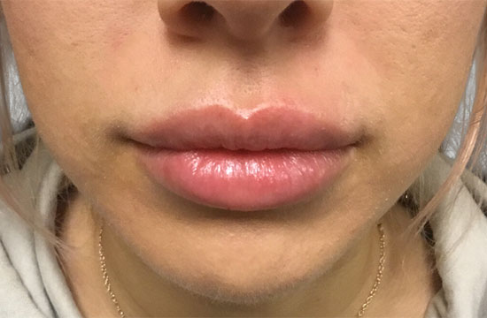 woman's lips after treatment