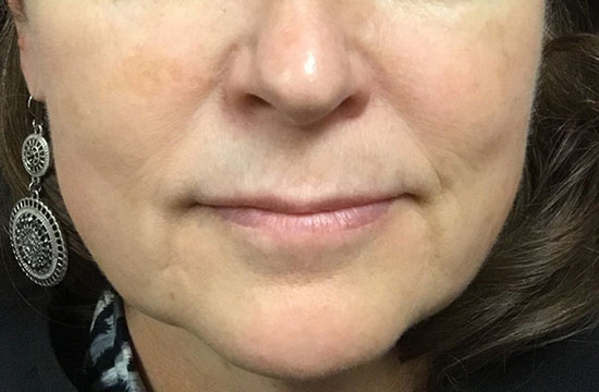 woman's lips before treatment