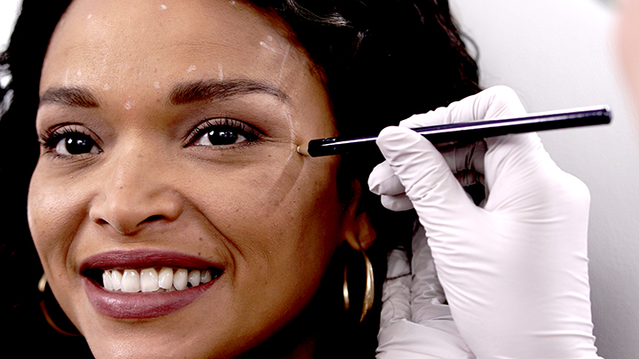 Ideal Image Medical Professional prepares to inject Botox into the forehead and crow's feet area of female client.