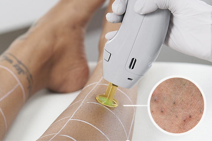 Medical professional performing laser hair removal on leg with close-up of strawberry legs
